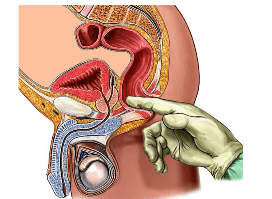 palpation of the prostate to diagnose prostatitis