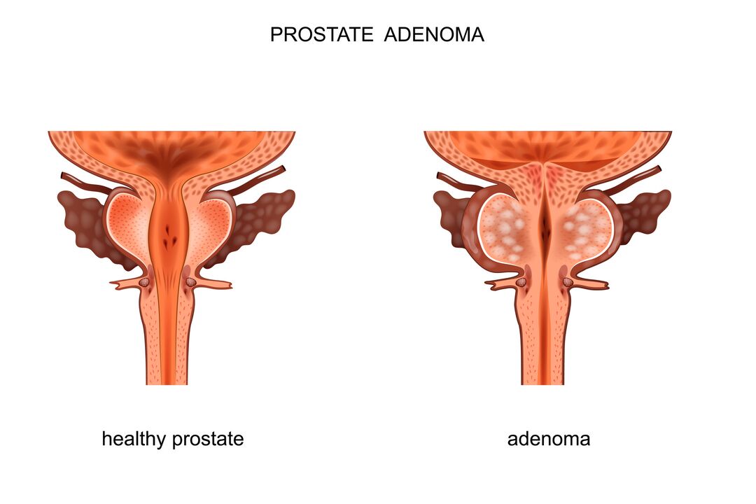 Healthy prostate and aden