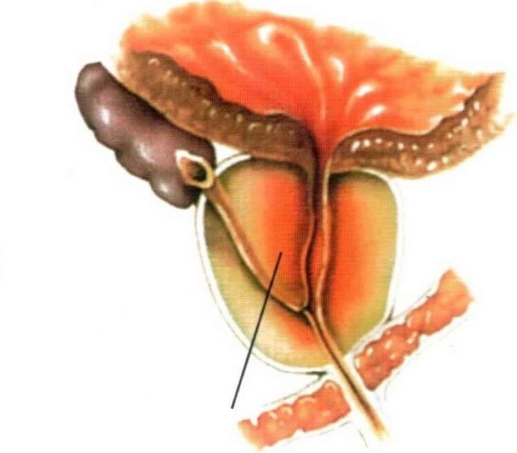 Inflammation of prostate tissue in chronic prostatitis